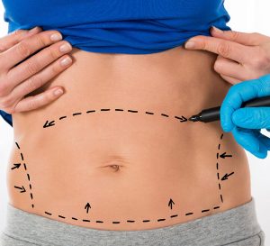 liposuccion ventre Tunisie