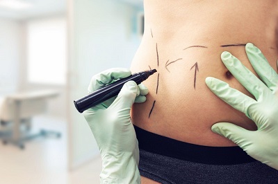 se preparer a la liposuccion