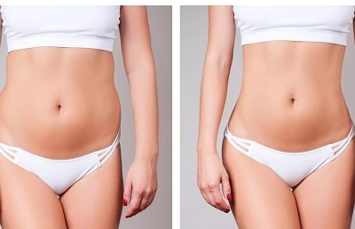 combien de kilos peut-on perdre avec une liposuccion