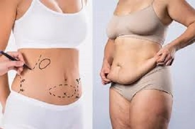 chirurgie reparatrice du ventre