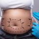 quel examen a faire avant une liposuccion