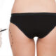 Combien de temps faut-il à la peau pour cicatriser après une liposuccion ?