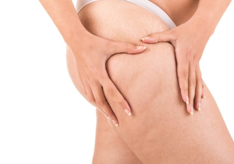 Combien de poids peut-on perdre avec une liposuccion des cuisses ?