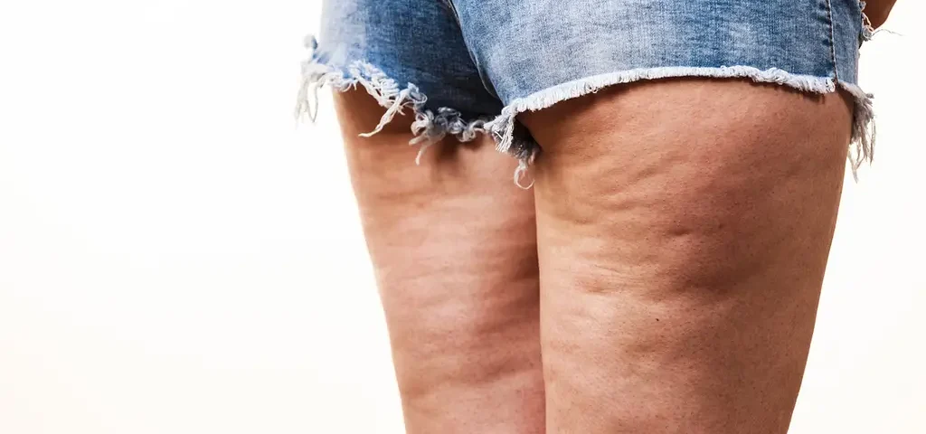 Comment se débarrasser des amas graisseux au niveau des mollets ?