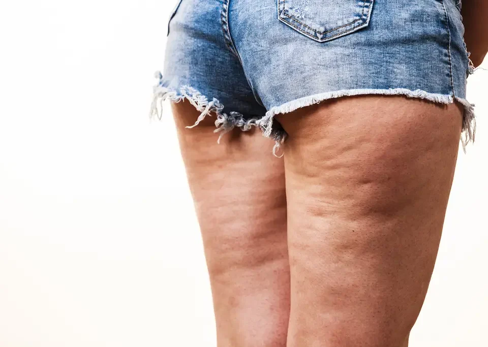 Comment se débarrasser des amas graisseux au niveau des mollets ?