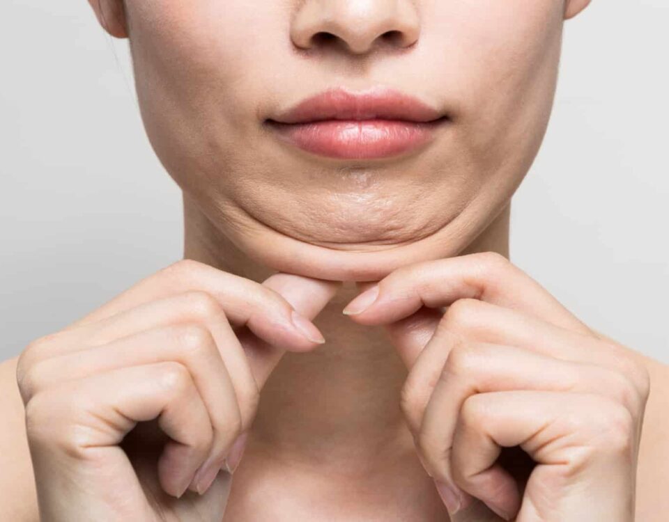 Comment se débarrasser du double menton sans chirurgie ?