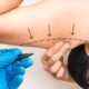 Combien de kilos perdez-vous avec une liposuccion des bras ?