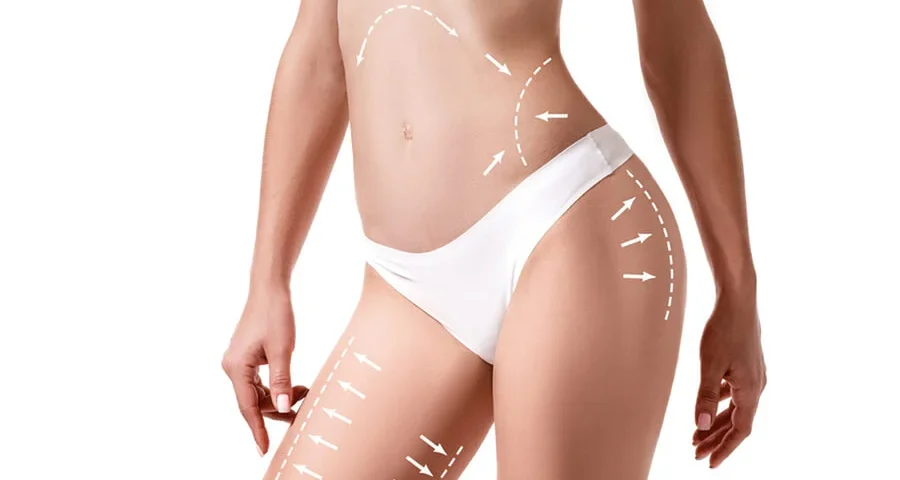 Quelles sont les 4 zones des cuisses qui peuvent bénéficier d'une liposuccion ?