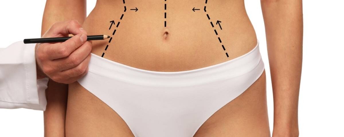 Qu'est-ce que la lipoaspiration haute définition (HD) ?