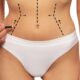 Qu'est-ce que la lipoaspiration haute définition (HD) ?
