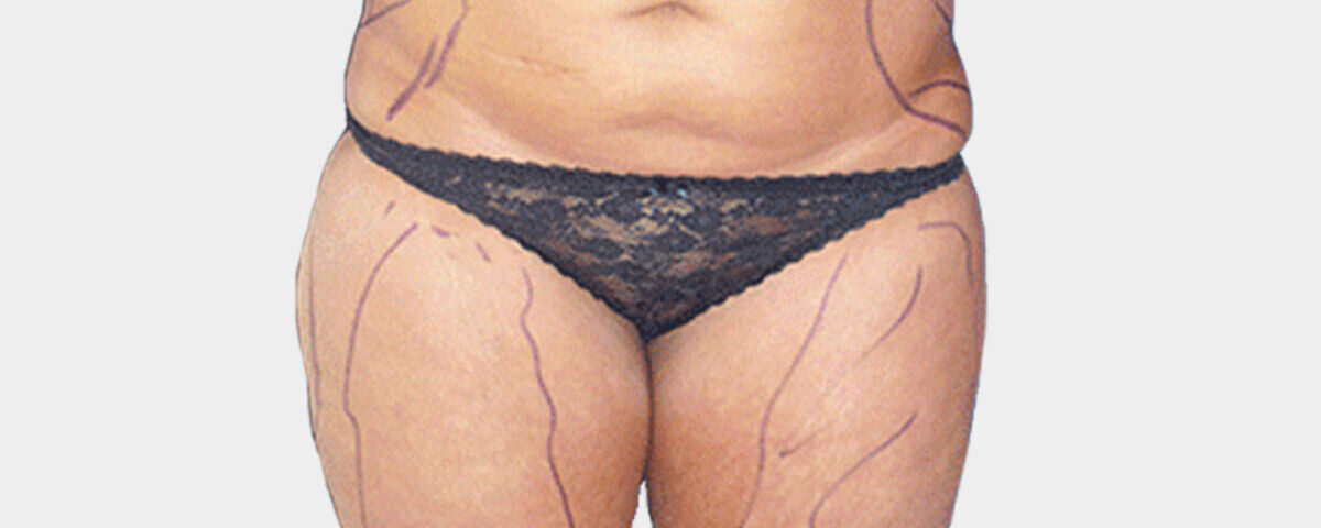 Est-ce que la liposuccion est possible en cas de surpoids ?