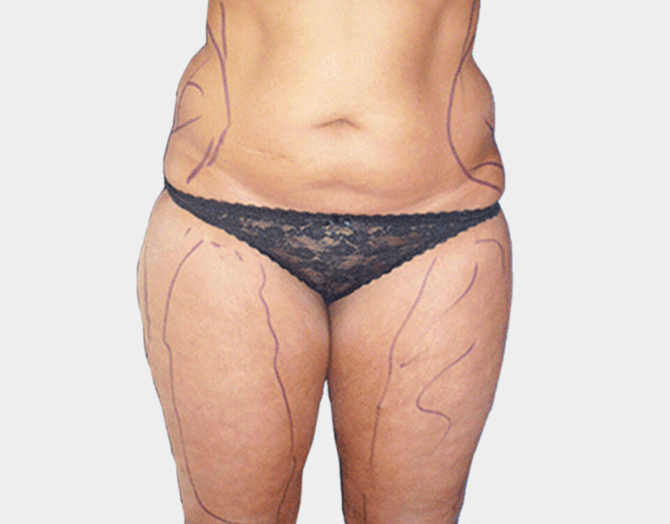Est-ce que la liposuccion est possible en cas de surpoids ?