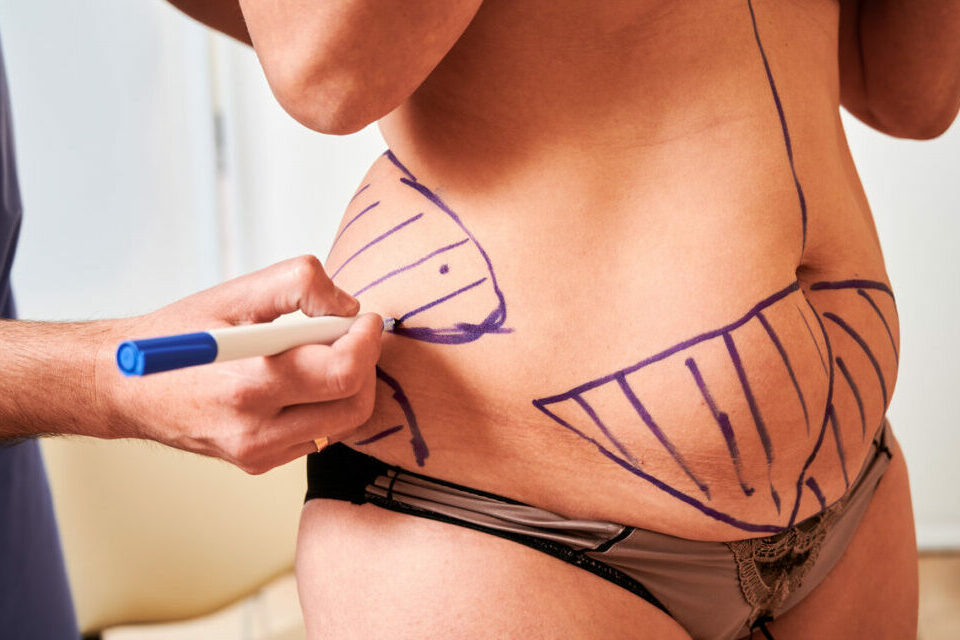 Combien de litres de graisse peut-on retirer au maximum avec une liposuccion ?