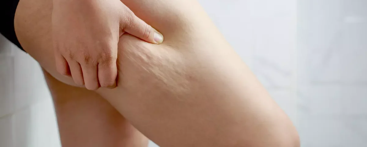 Combien de temps faut-il pour que les incisions de liposuccion guérissent ?