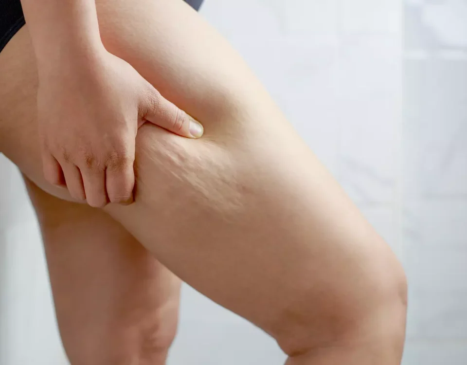 Combien de temps faut-il pour que les incisions de liposuccion guérissent ?