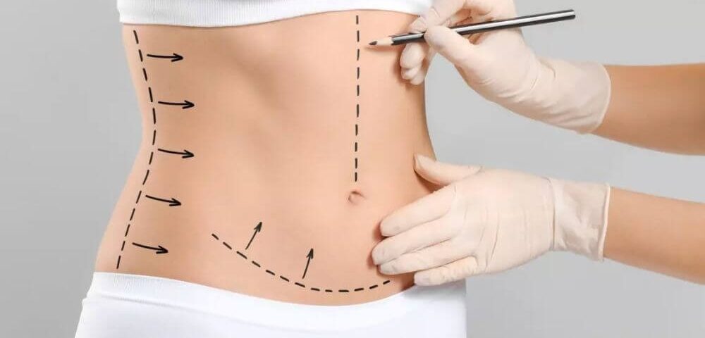 Est-ce que la lipoaspiration nécessite une anesthésie locale ?