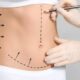 Est-ce que la lipoaspiration nécessite une anesthésie locale ?