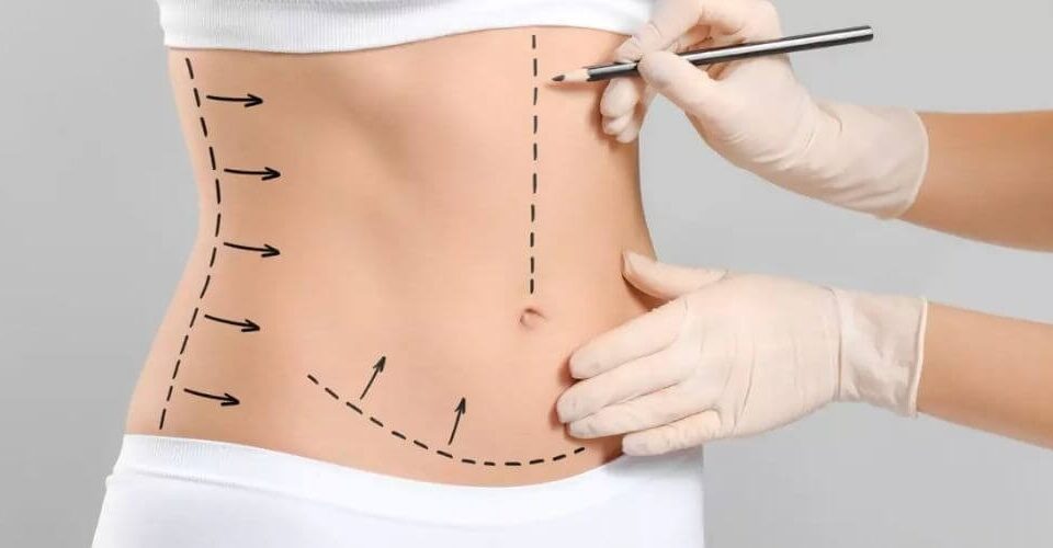 Est-ce que la lipoaspiration nécessite une anesthésie locale ?