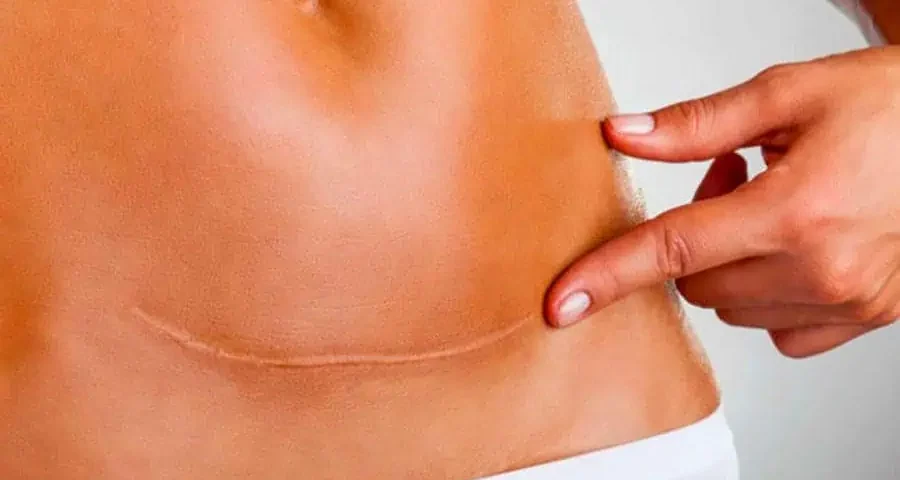 Est-ce que les cicatrices d'une liposuccion du ventre sont visibles ?