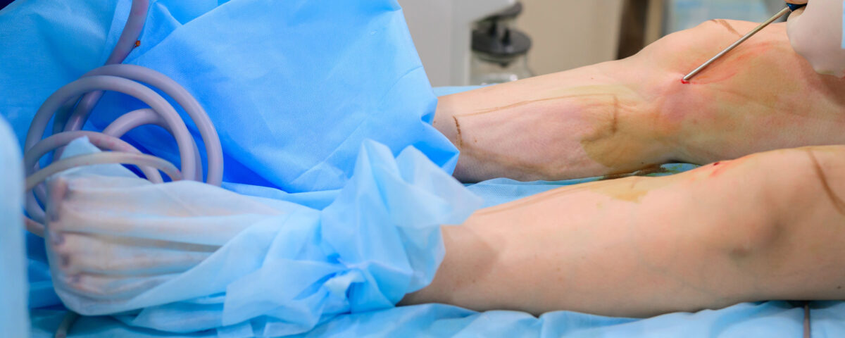 La liposuccion est-elle efficace pour la graisse du genou ?