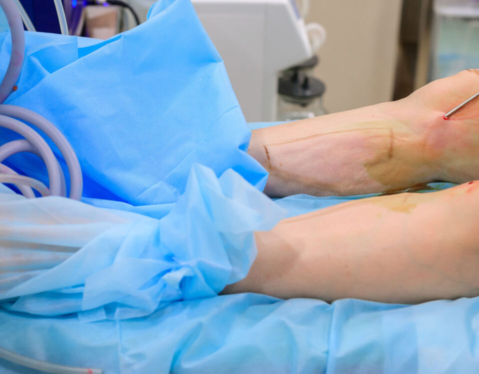 La liposuccion est-elle efficace pour la graisse du genou ?