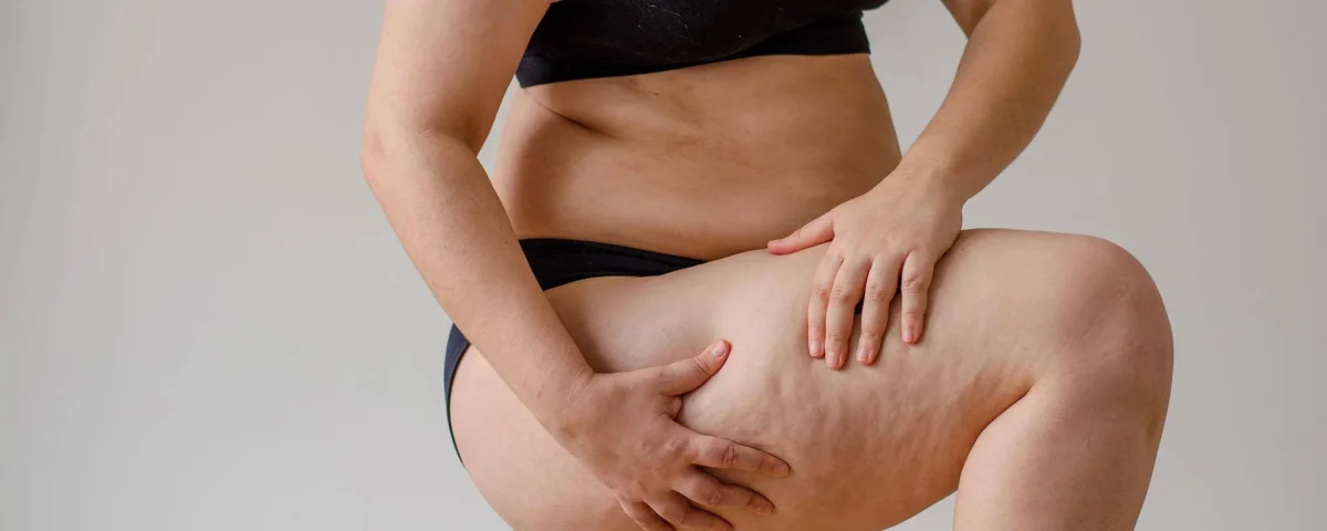 Traitement du Lipœdème par VibroFit en Tunisie