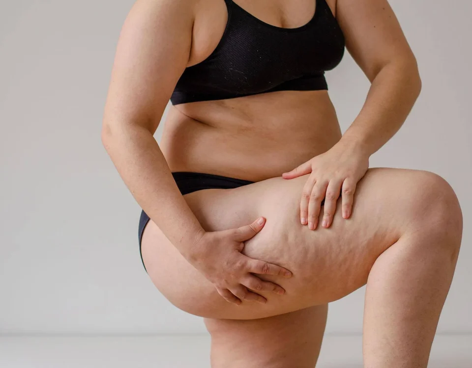 Traitement du Lipœdème par VibroFit en Tunisie