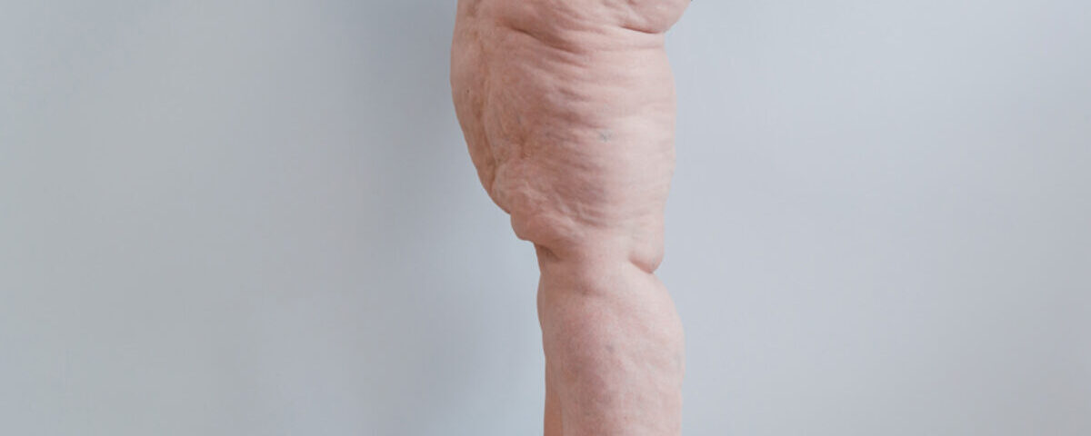 Traitement du Lipœdème par ArgoPlasma en Tunisie