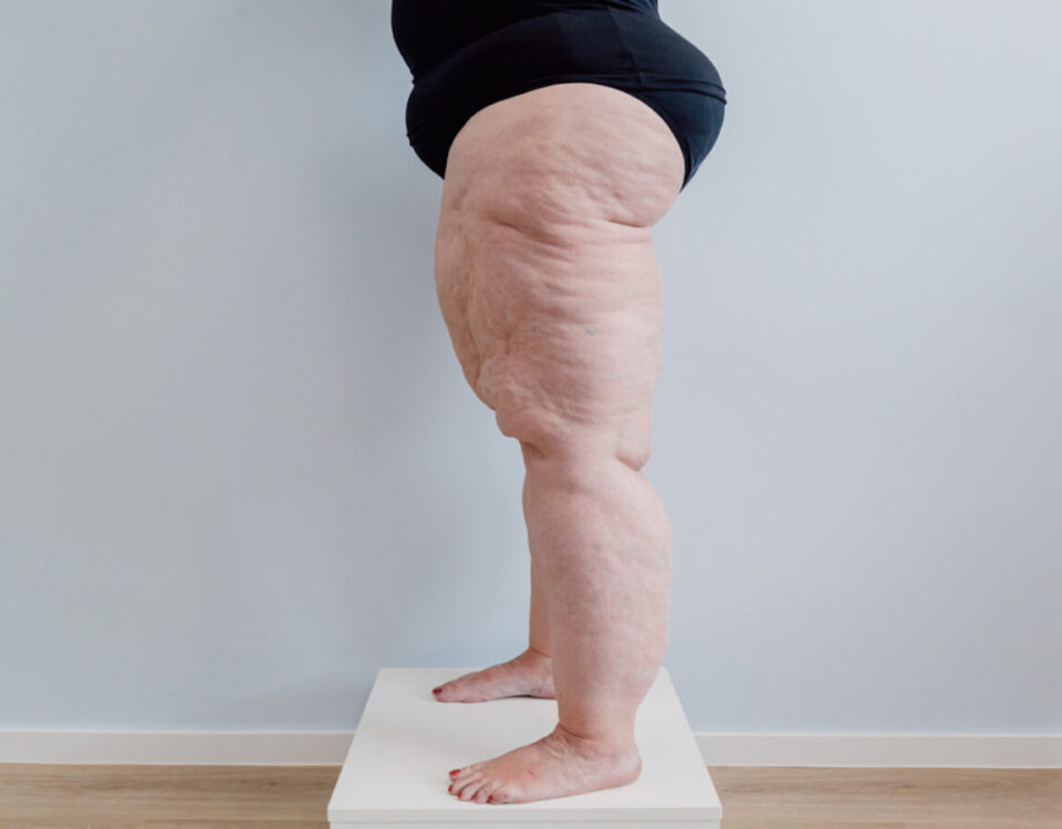 Traitement du Lipœdème par ArgoPlasma en Tunisie