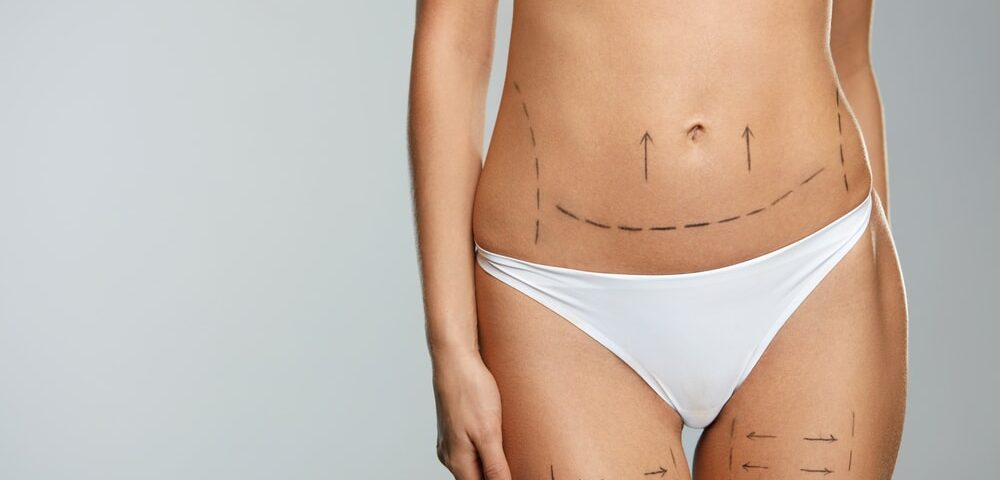 Traitement du Lipœdème par BodyTite