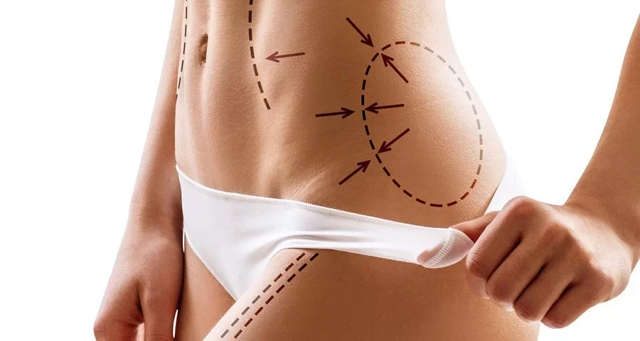 BodyTite vs BodyTite + Quantum RF