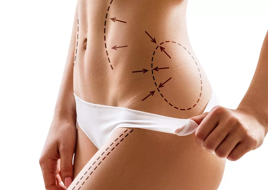 BodyTite vs BodyTite + Quantum RF