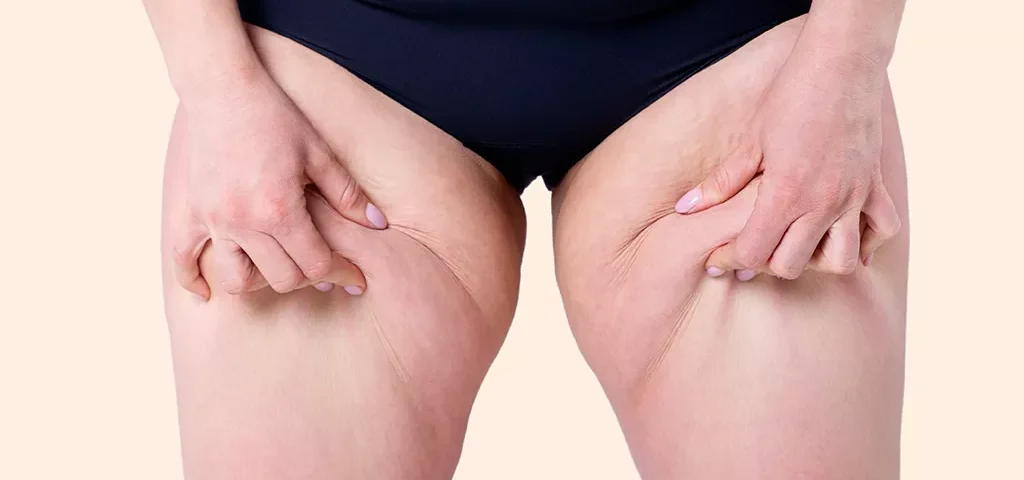 Chirurgie du Lipoedème en Tunisie