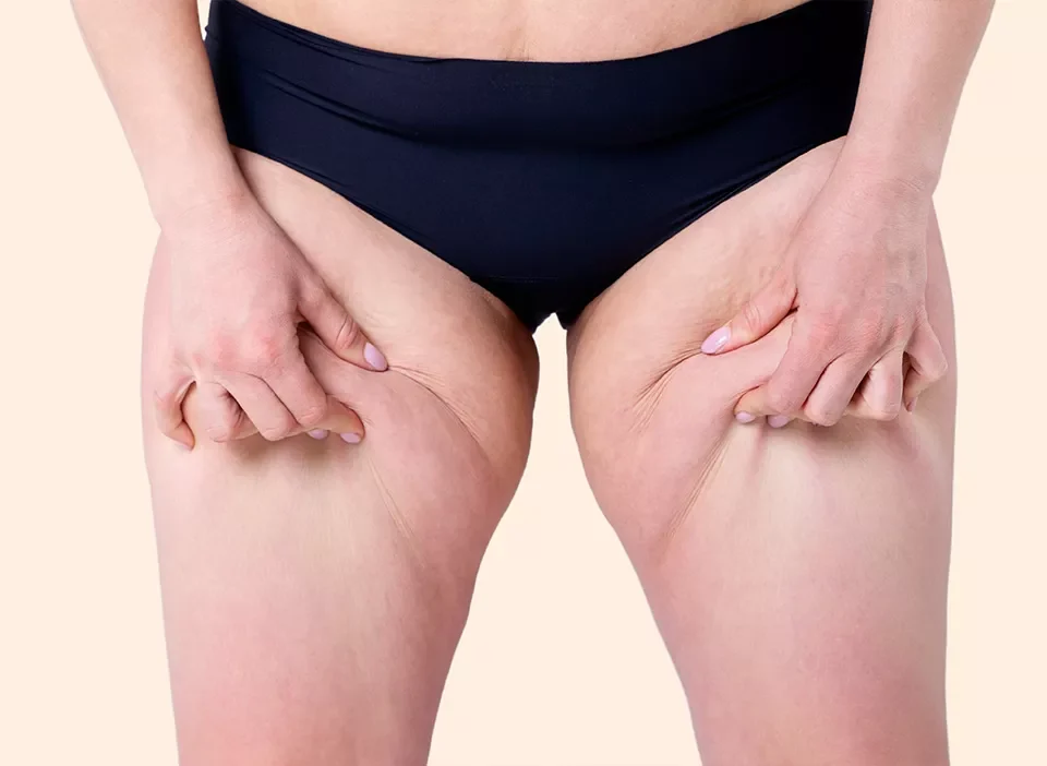 Chirurgie du Lipoedème en Tunisie