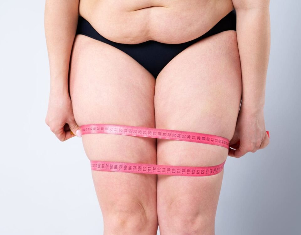 Lipoédème et Jambes Poteaux