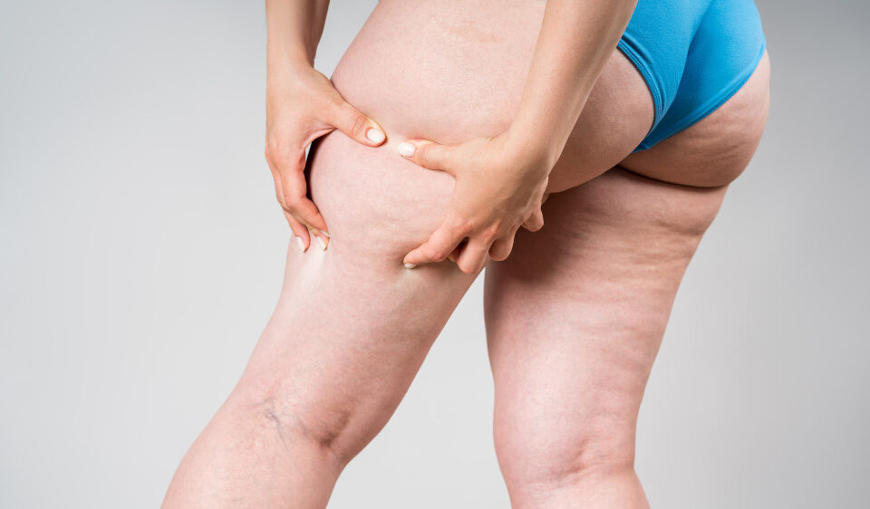 Lipœdème et Remodelage Corporel