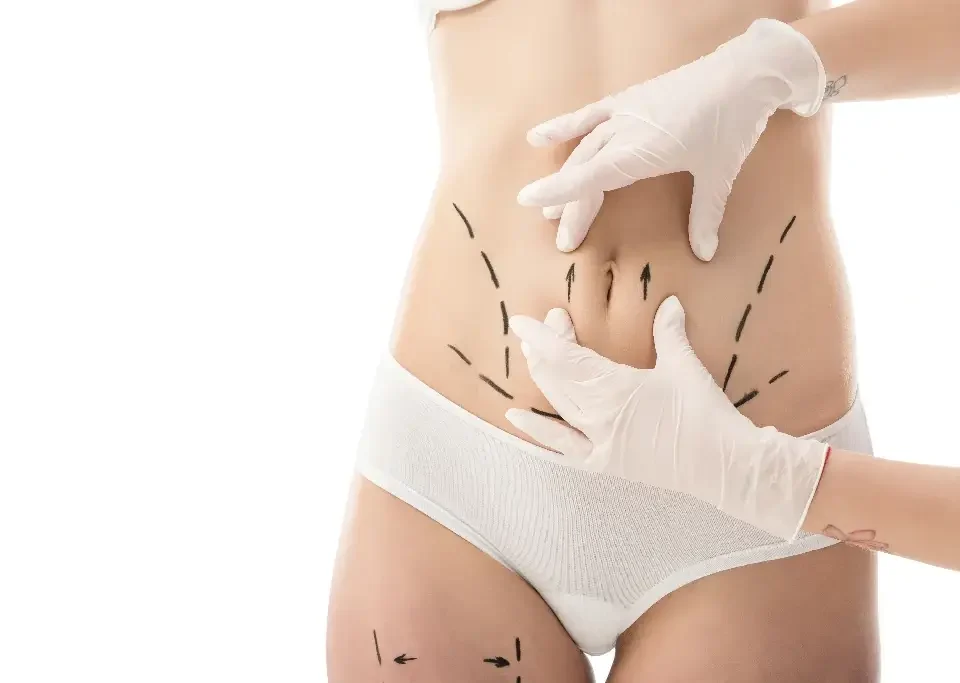 Comment choisir le meilleur chirurgien pour une liposuccion moderne ?