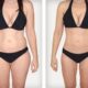 Liposuccion combinée jambes + bras