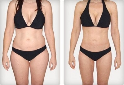 Liposuccion combinée jambes + bras