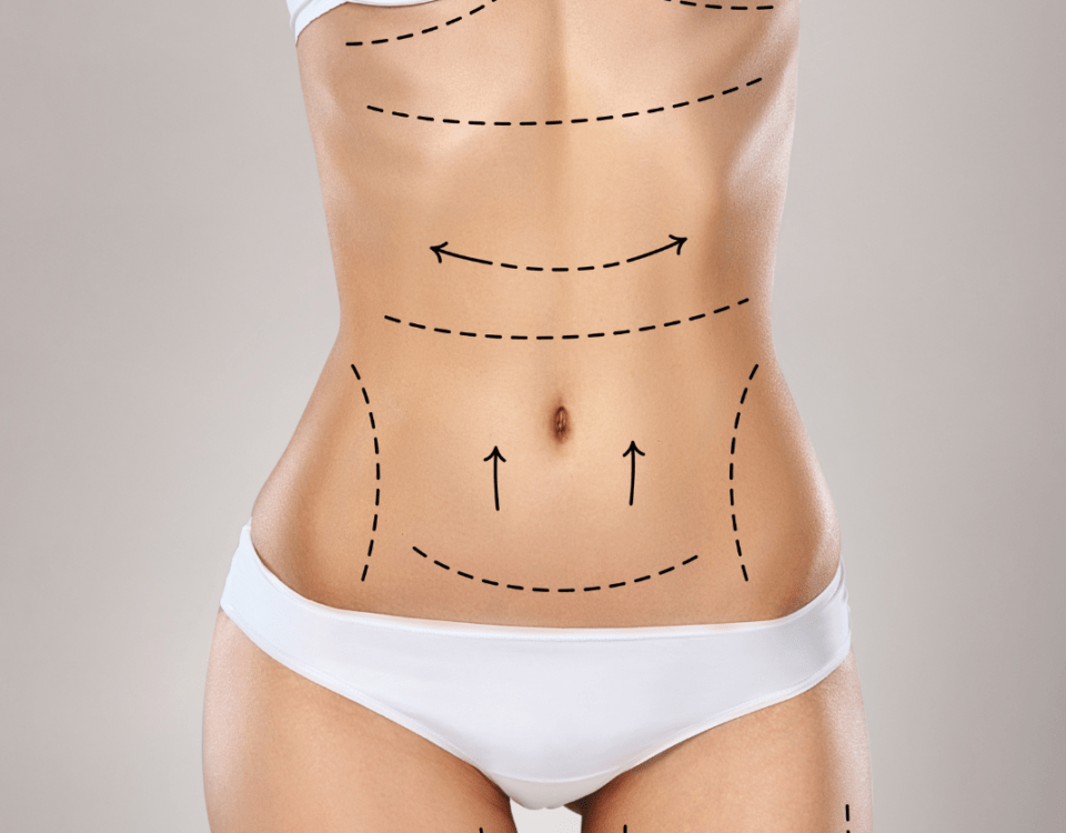 Liposuccion tumescente pour lipœdème