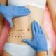 Chirurgie de Liposuccion PAL en Tunisie