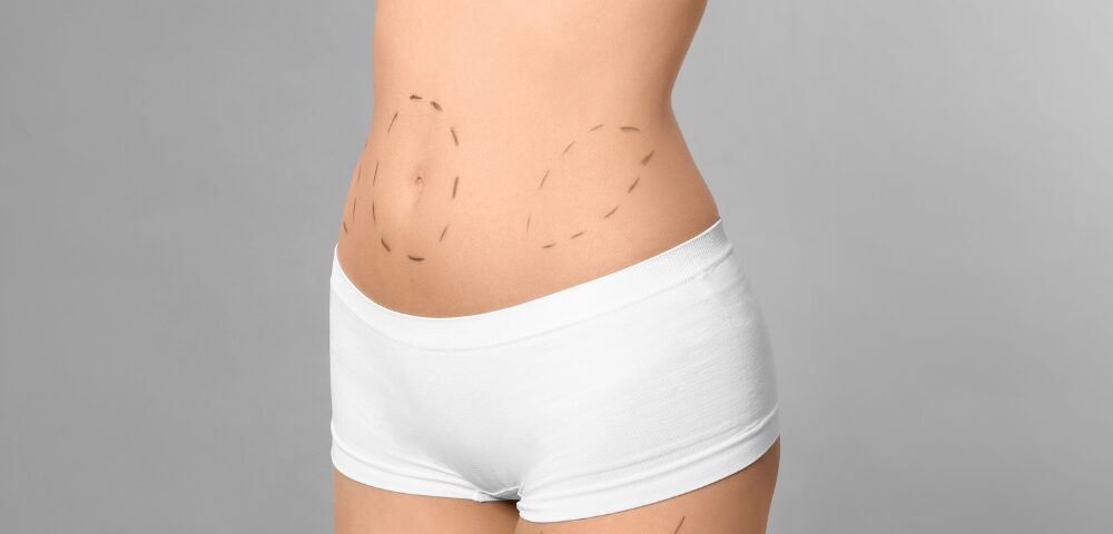 Liposuccion 360° et body contouring