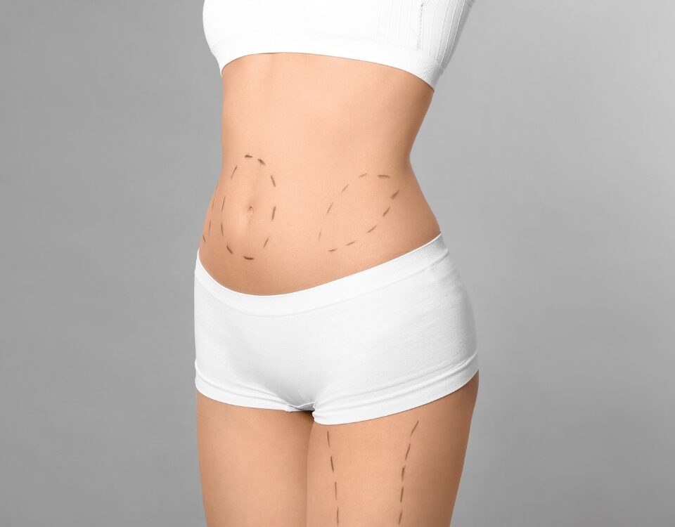 Liposuccion 360° et body contouring
