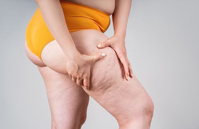 Traitement du Lipolymphœdème en Tunisie