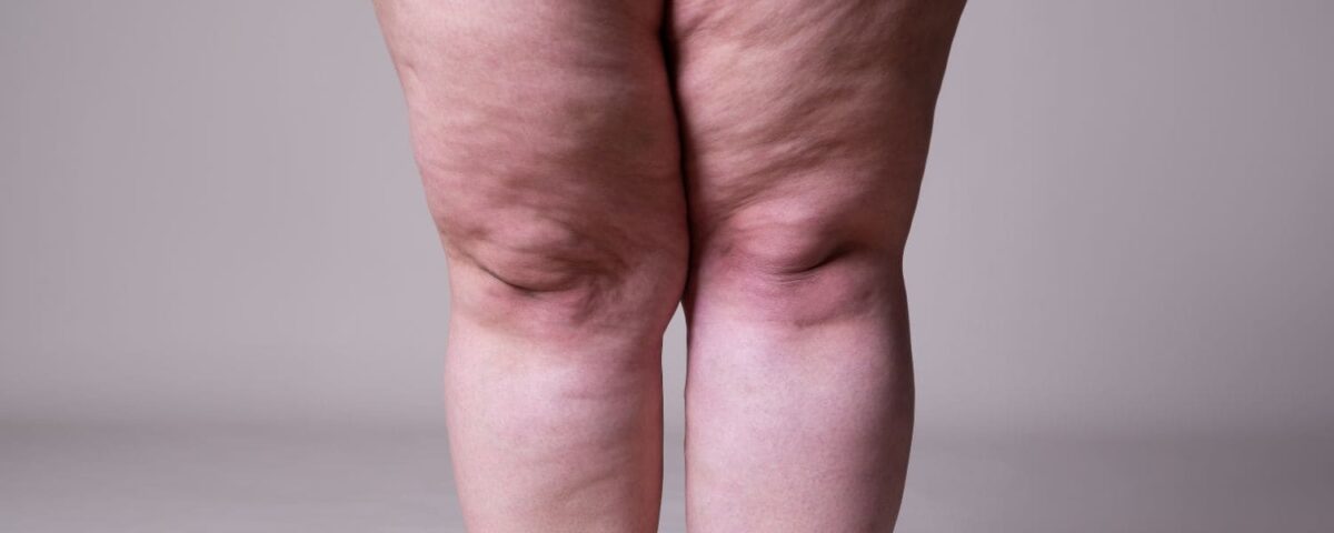 Traitement du lipœdème sévère en Tunisie