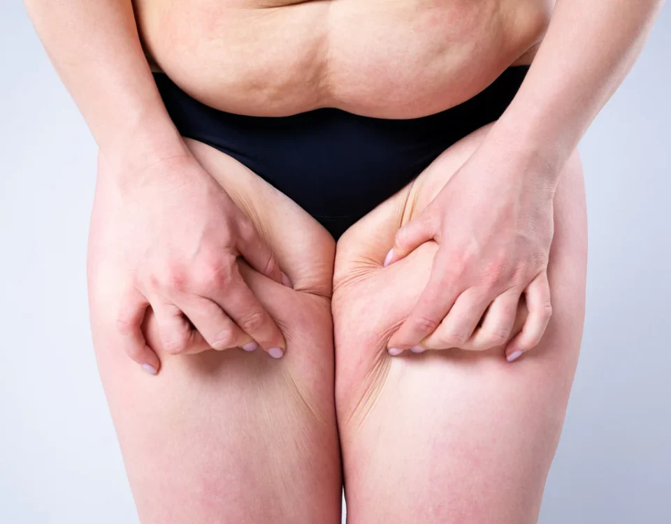 Traitement du lymphœdème en Tunisie