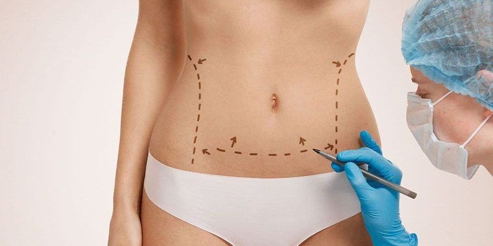 Lipœdème et hormones