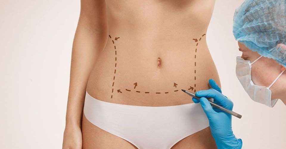 Lipœdème et hormones