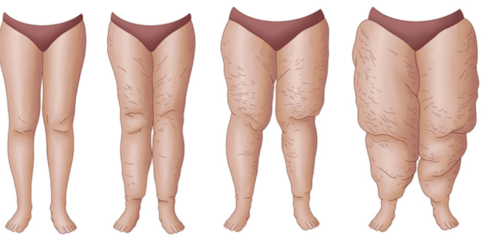 Lipœdème et technique 4-Tech