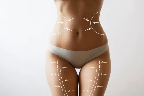 Liposuccion + Renuvion (J-Plasma)